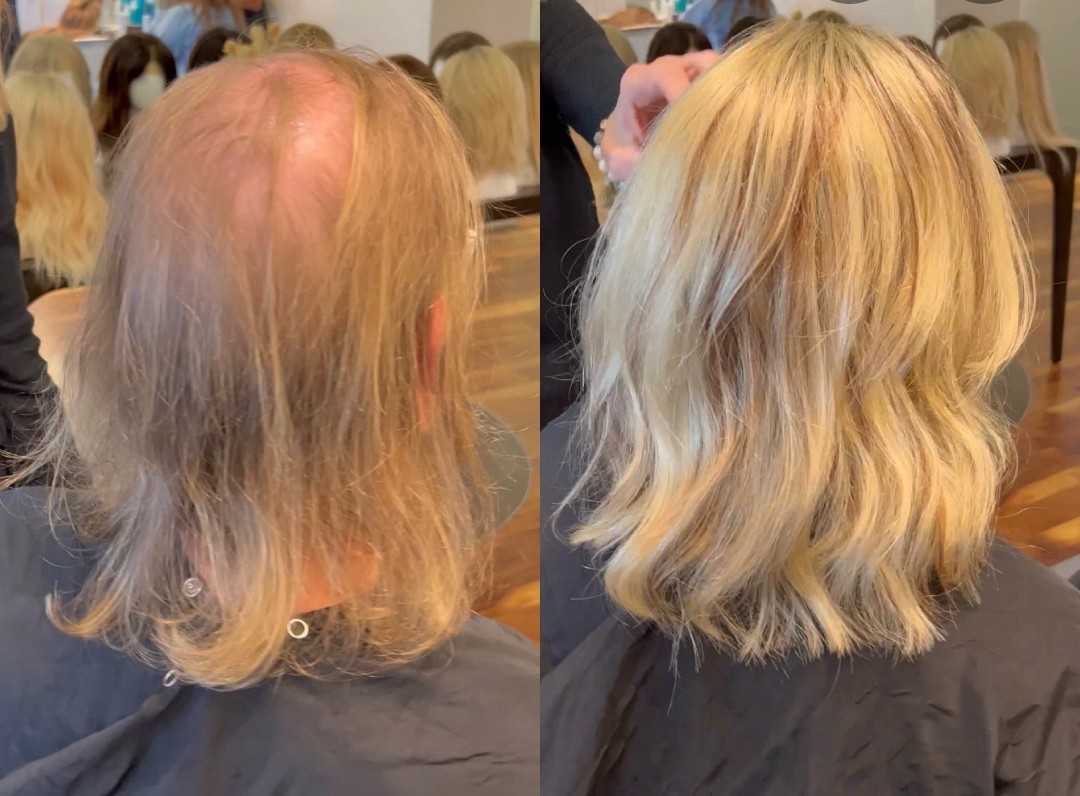 Women's Hair Restoration Solutions